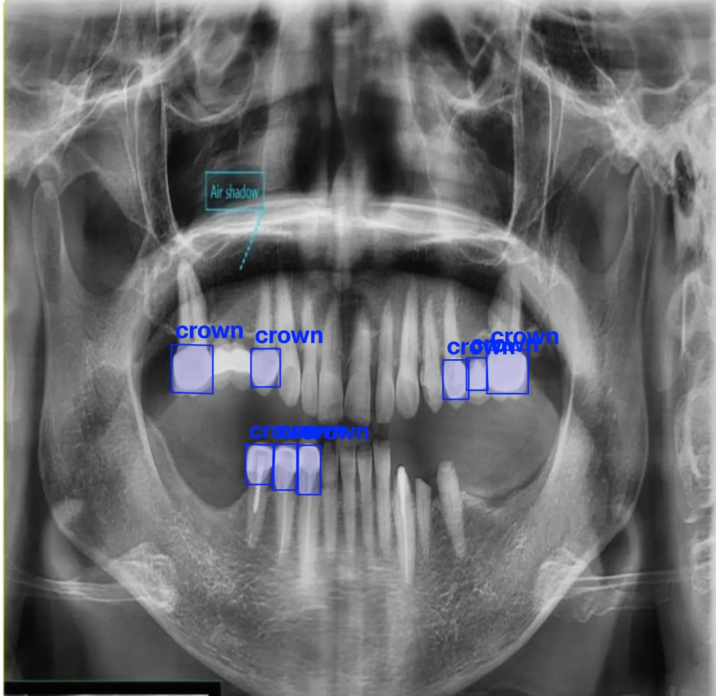 Dental Prosthetic Crown Detection X-rays