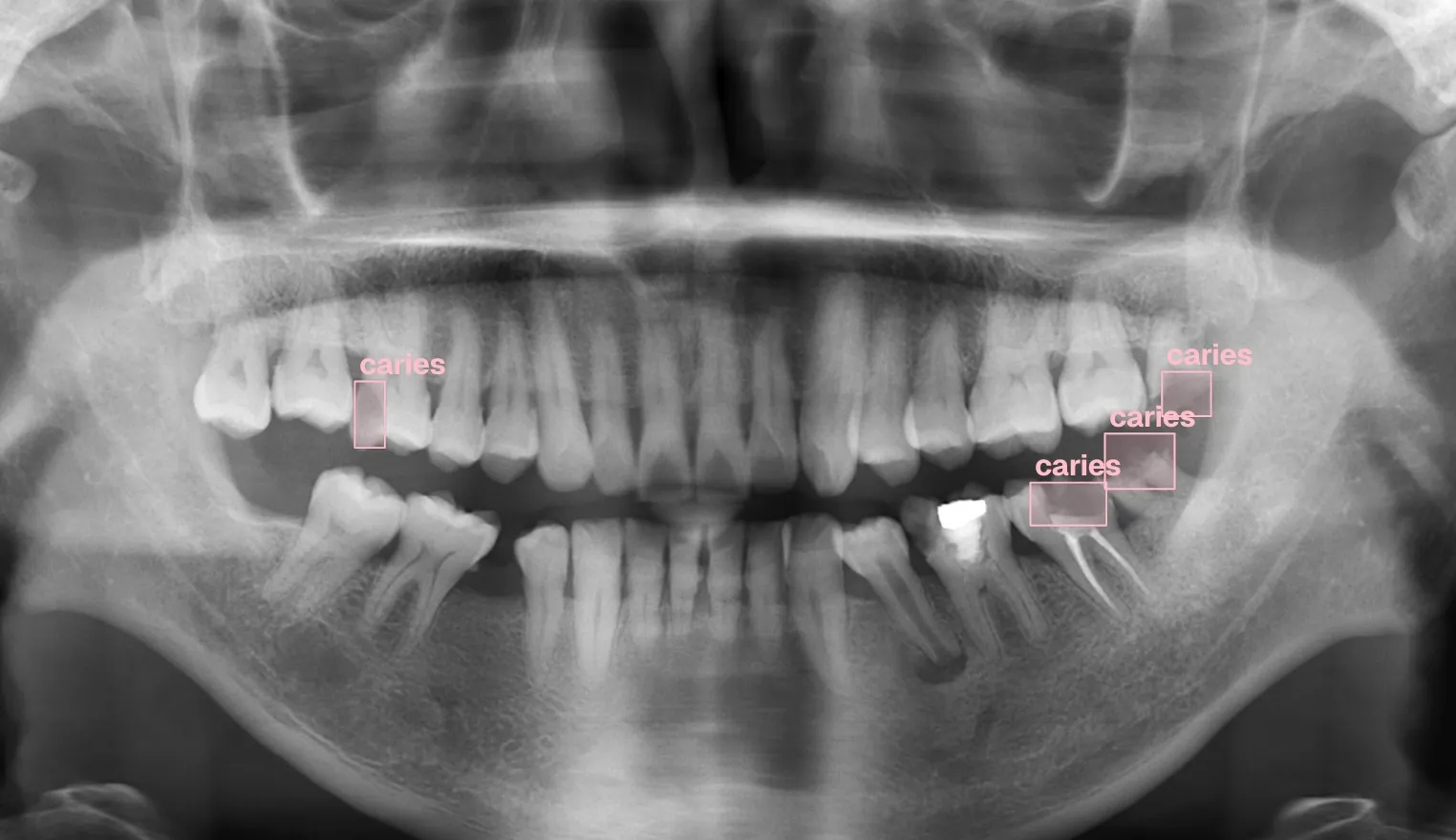 Dental Caries Detection X-ray