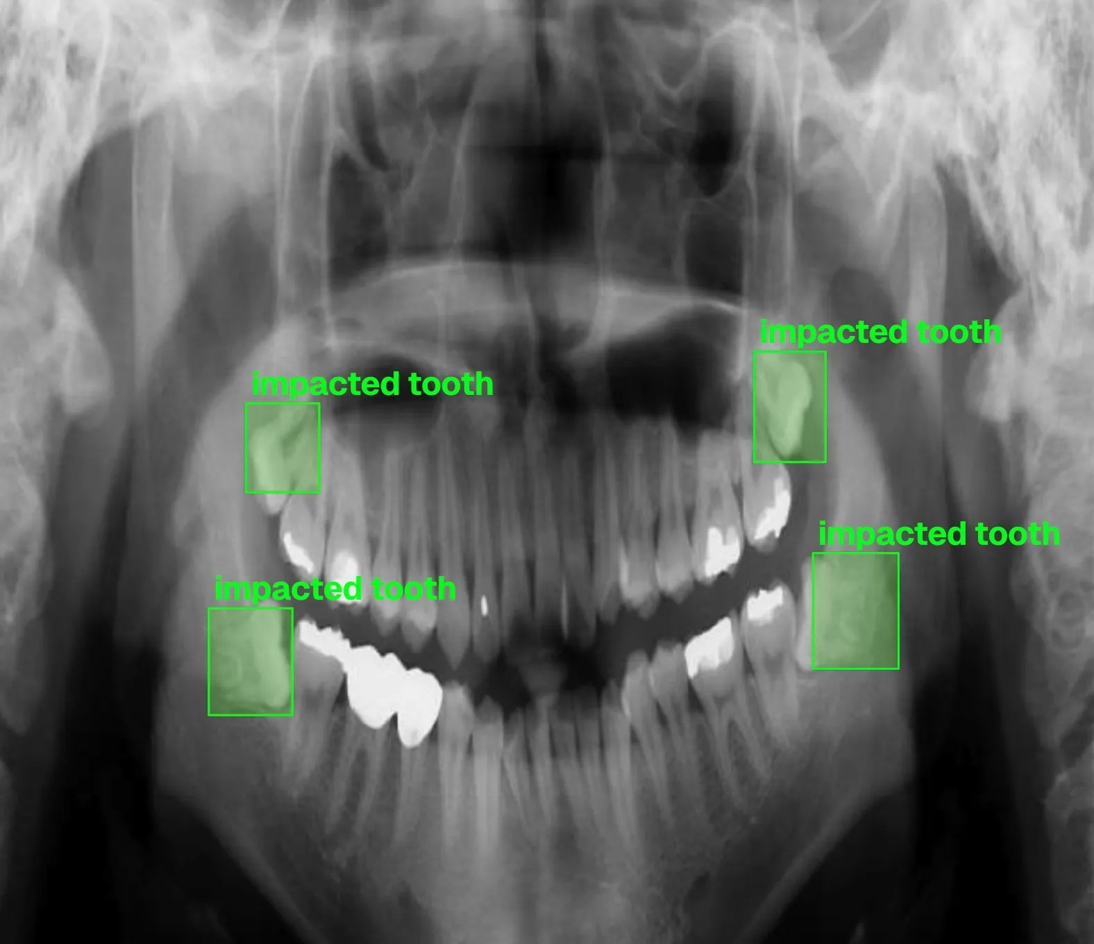 Impacted Tooth Detection X-rays