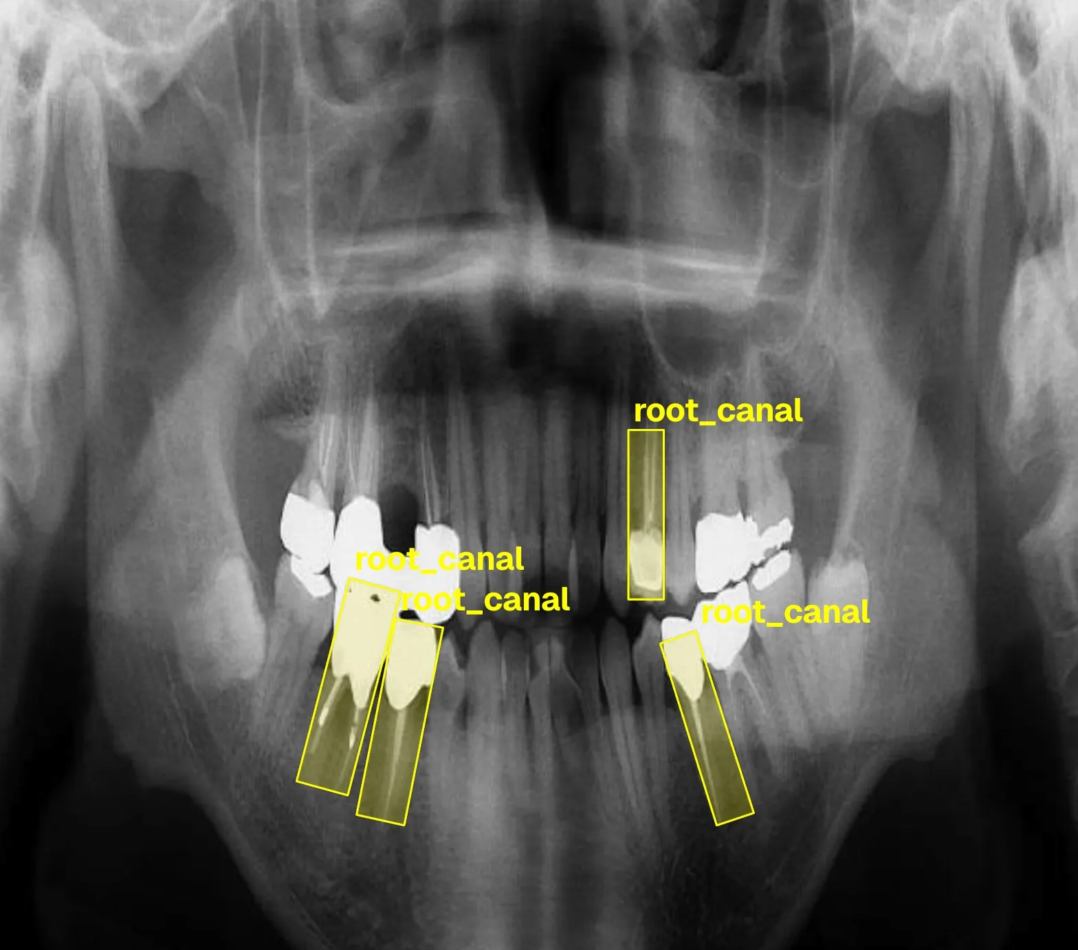 Root Canal Detection X-ray